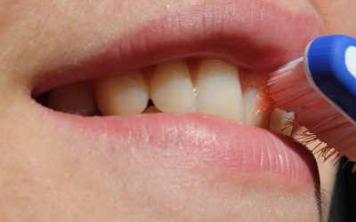 What is gingivitis?