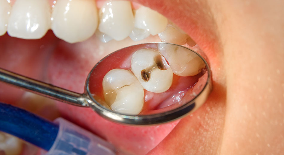 6 Important Facts About Cavities