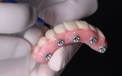 How do All-on-Four dental implants compare to traditional implants?
