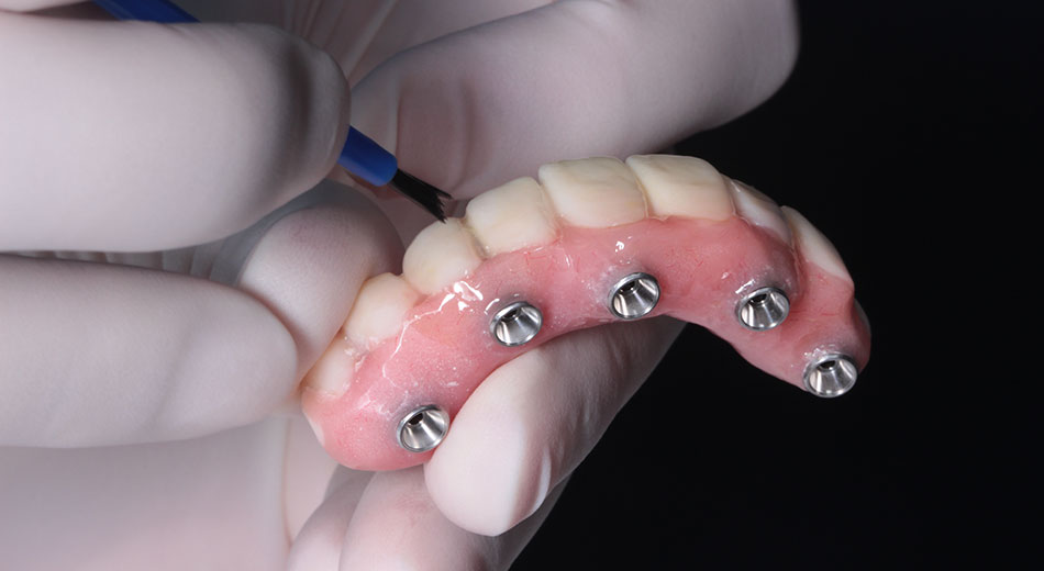 How do All-on-Four dental implants compare to traditional implants?