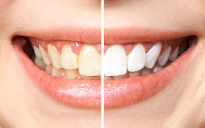 What are the advantages of teeth whitening at the dentist?