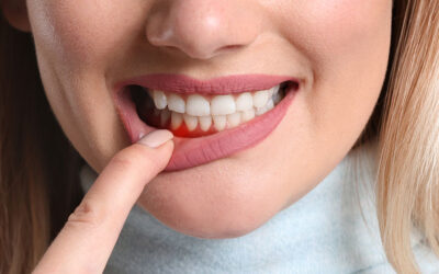 How to Detect and Treat Gingivitis