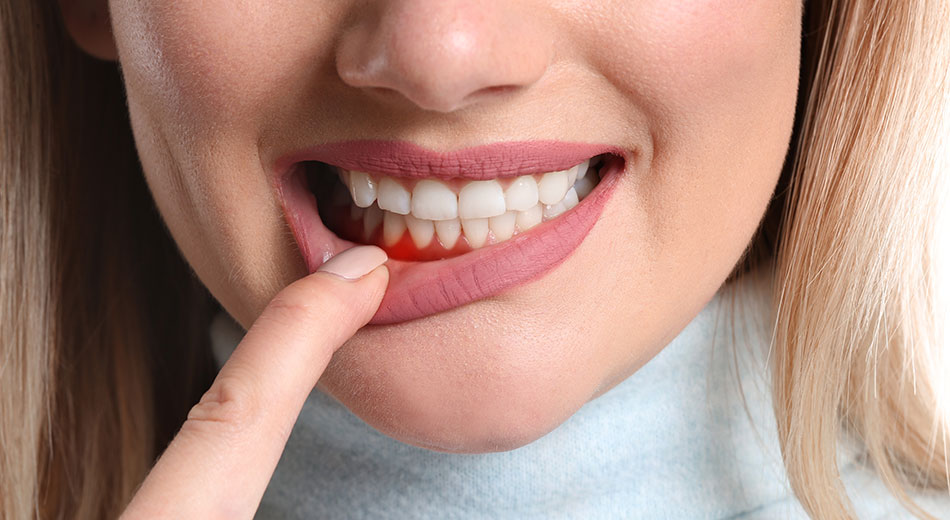 How to Detect and Treat Gingivitis