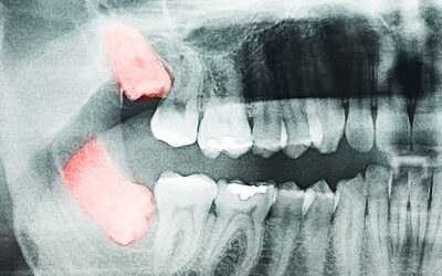 Understanding the Benefits of Wisdom Teeth Removal