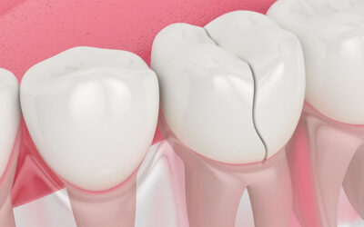 Cracked Teeth: A Comprehensive Guide To Causes, Symptoms, And Treatments