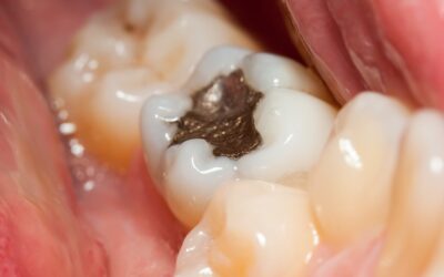 Dental Filling Options Explained